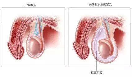 两个月宝宝蛋蛋有积液，原因、影响与处理方法